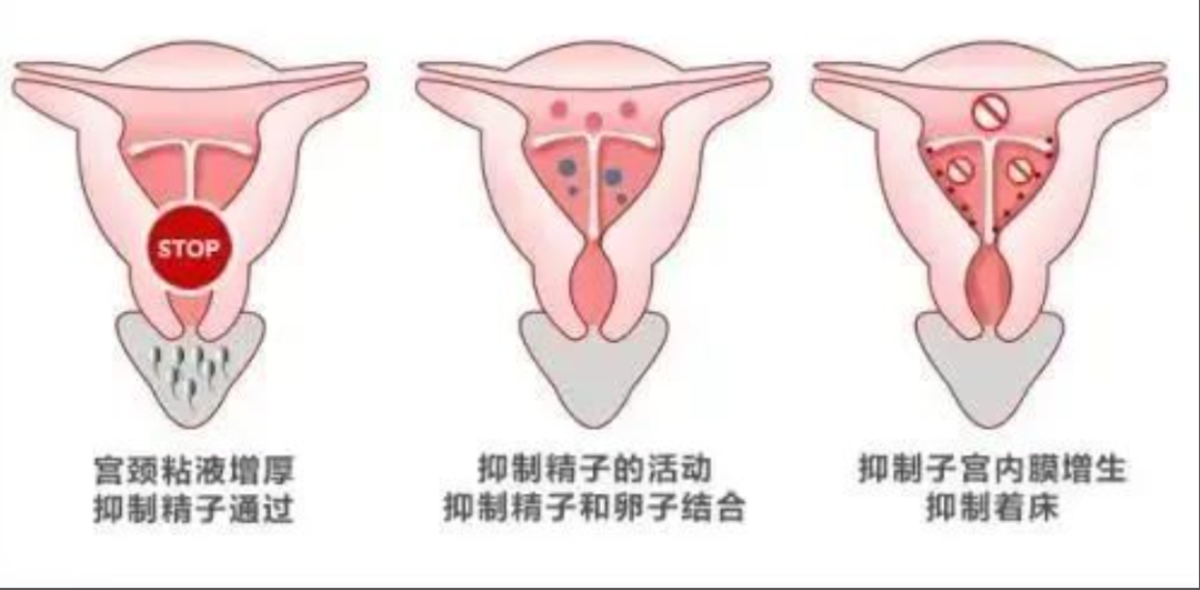 放置节育环：防身VS伤身，来看看