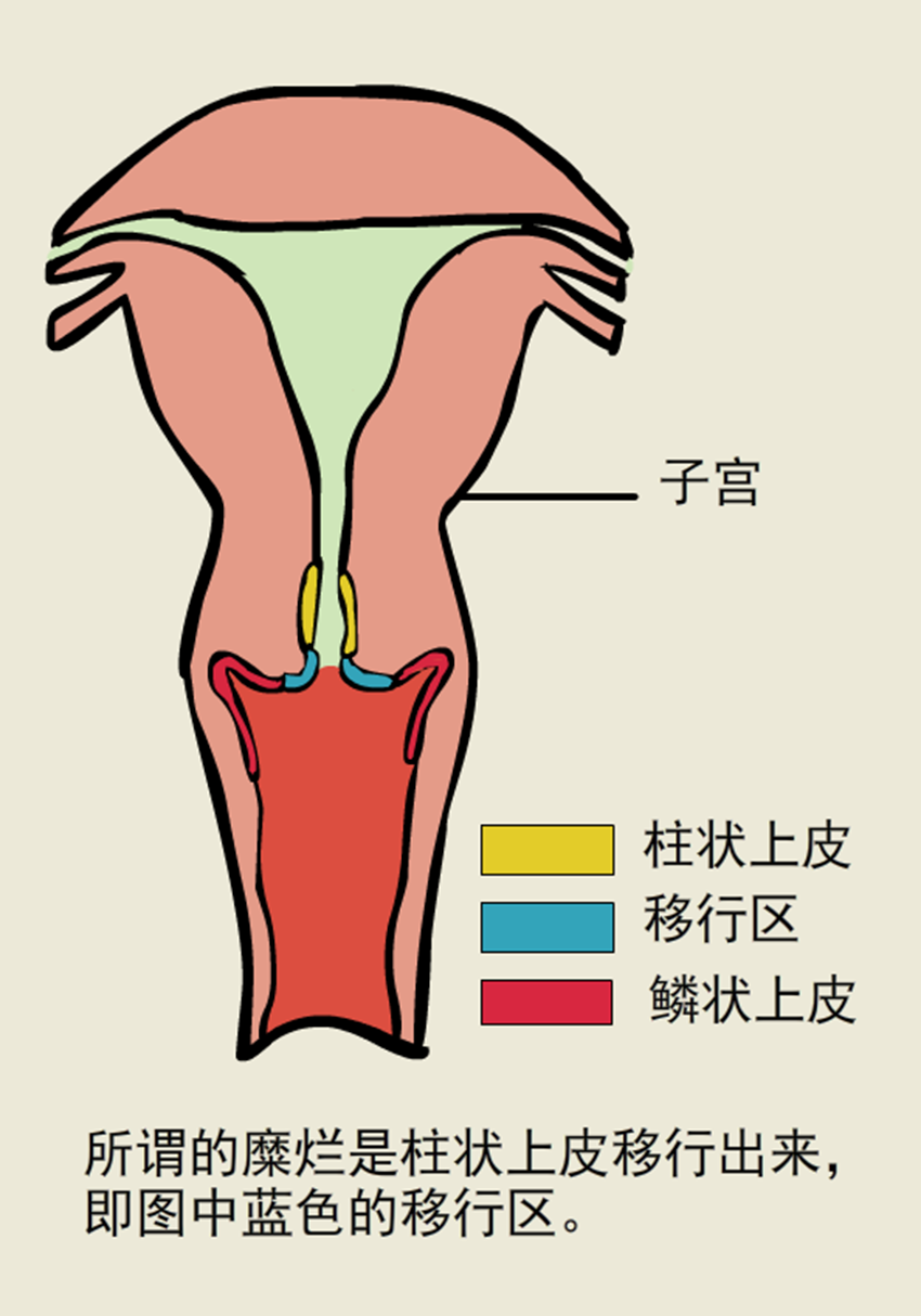 宫颈糜烂实则是柱状上皮移行的表现