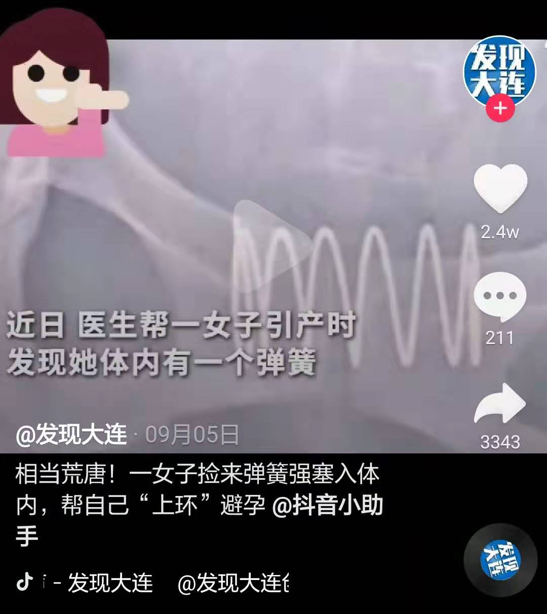 你理解的避孕节育环是怎样的