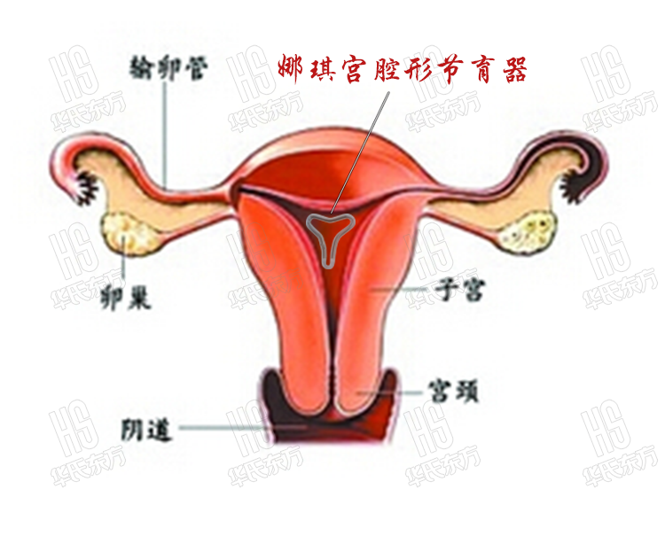 宫腔形娜琪节育器子宫形态