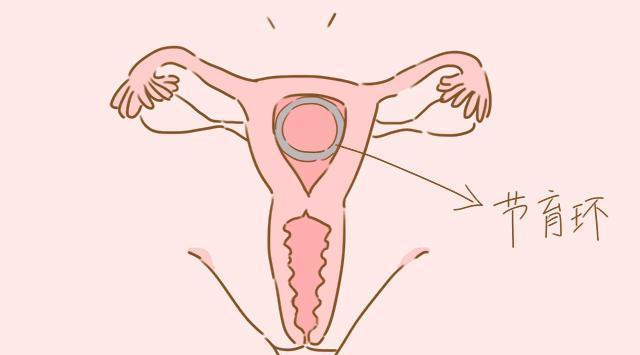 避孕环在子宫内位置