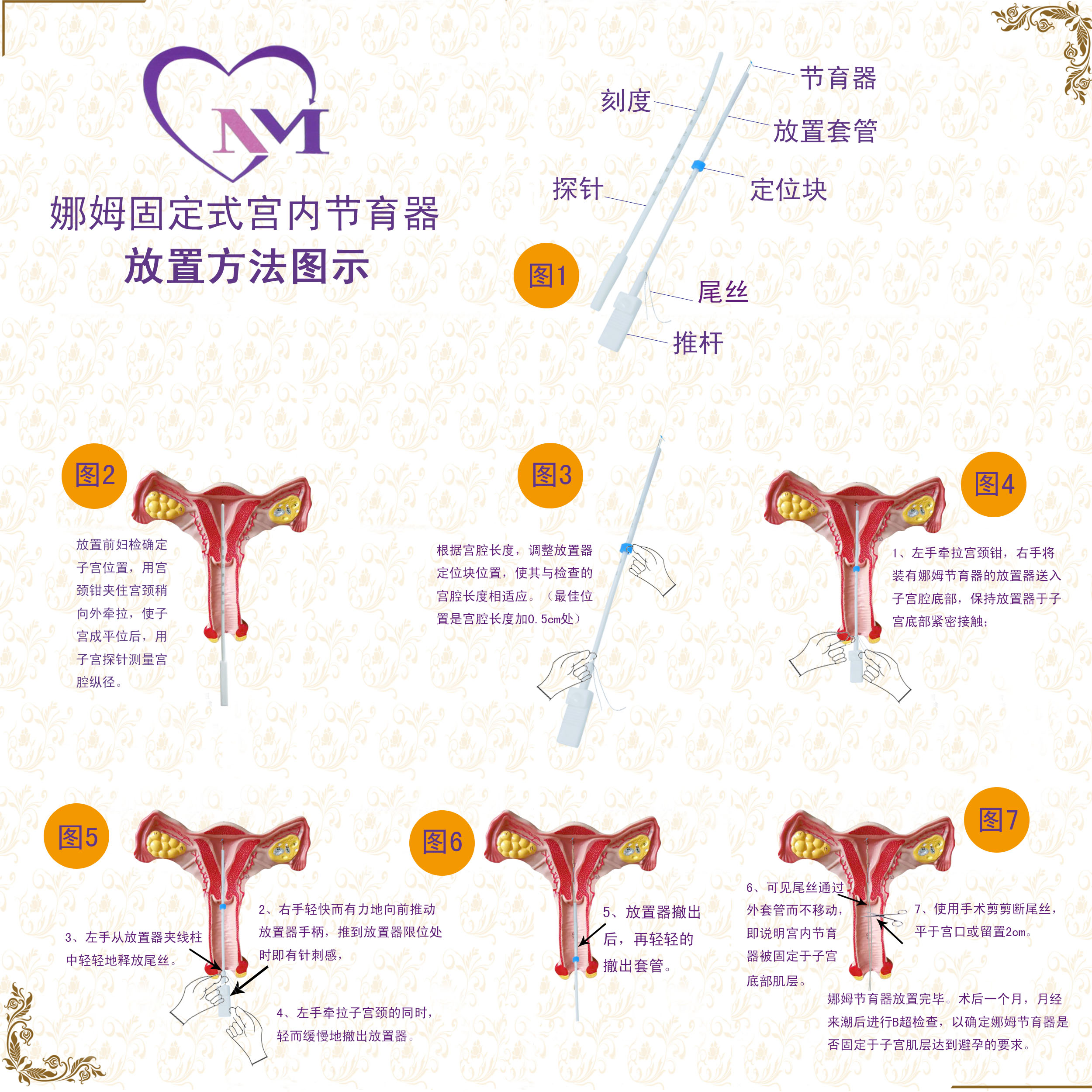 娜姆节育器放置图示