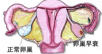 卵巢早衰和正常卵巢的区别