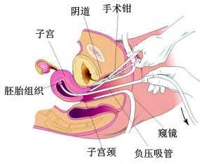 人流手术图解 人流手术图解