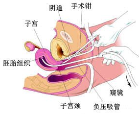 人流手术图解