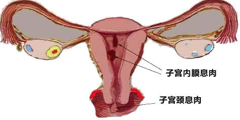 子宫内膜息肉和子宫颈息肉