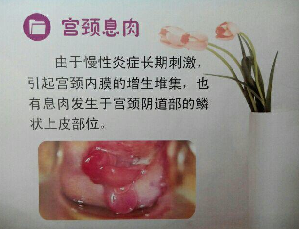 宫颈息肉的起因 宫颈息肉的起因