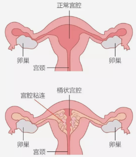 宫腔粘连