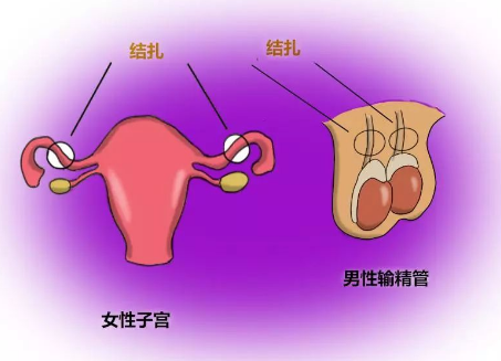 准确的说，结扎不是避孕，而是绝育